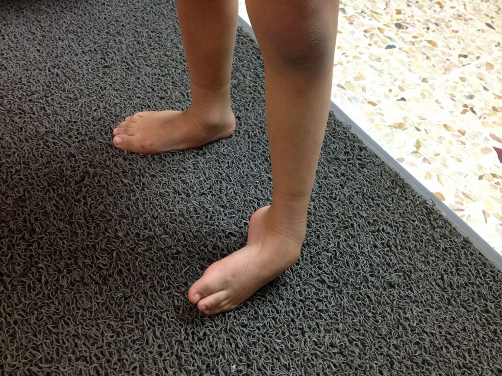 Pie Equinovaro Congénito Dr Luis Gabriel Pimiento