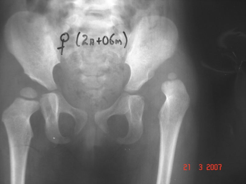 Displasia De Cadera - Dr Luis Gabriel Pimiento